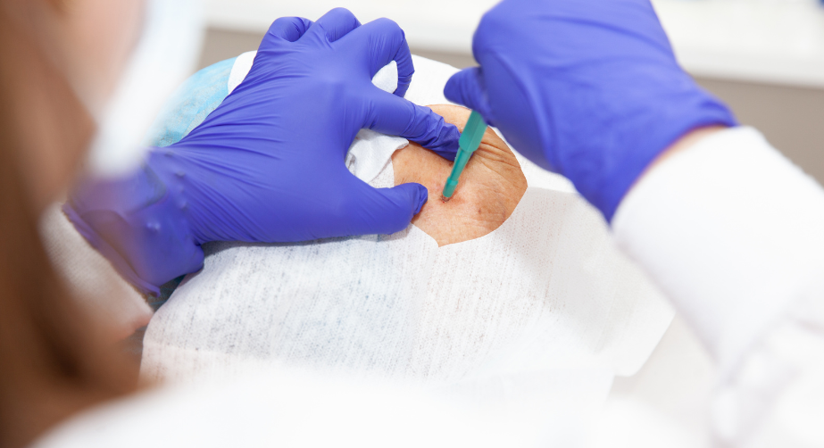 Procedimento dermatológico de biópsia